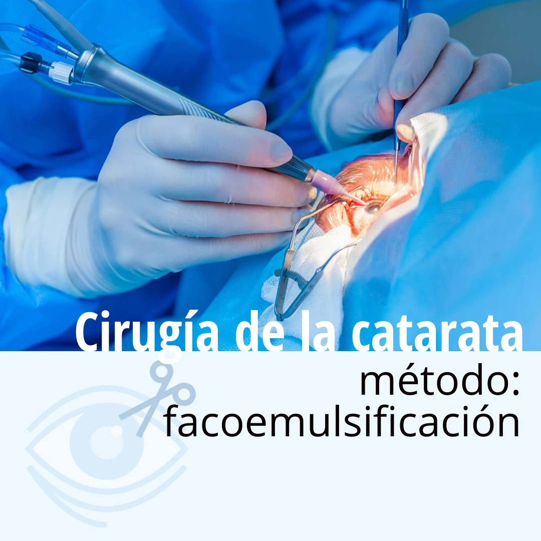 Cirugía de la catarata, facoemulsificación | Dr. Mario Lovatón, oftalmólogo, cirujano oftalmológico